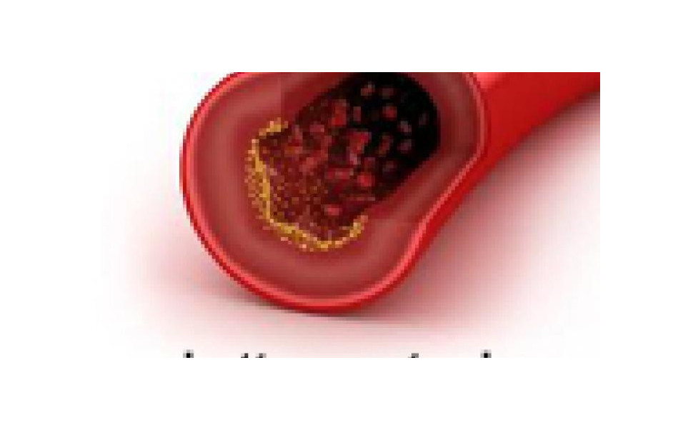 Cholesterol - Partie 2 : Lutter contre l'excès de cholesterol